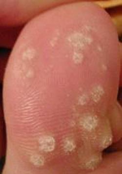 luchshe prosto zhenshin simptomi papillomavirus cheloveka u horoshaya ideya Папилломавирус человека симптомы у женщин фото