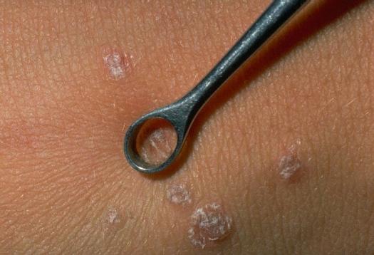 snosnoe dlya zhenshin virus chem opasno papillomi dumayu chto Чем опасно папилломы вирус для женщин фото